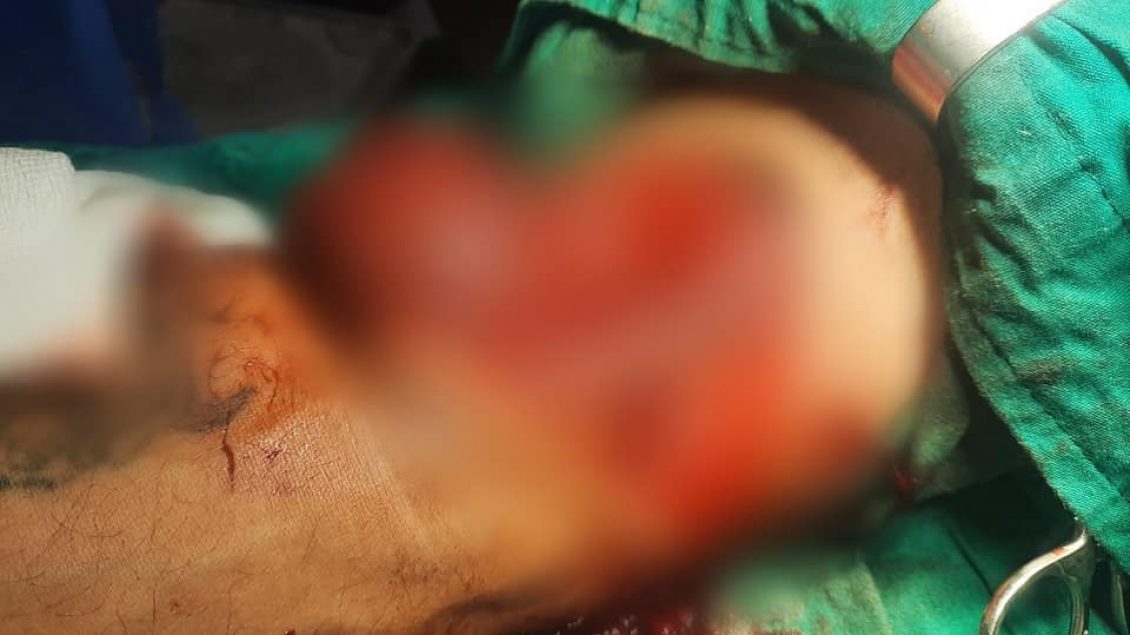 operacion-i-rralle-ne-qkuk,-i-shpetohet-krahu-pacientit-qe-pothuajse-e-kishte-te-amputuar