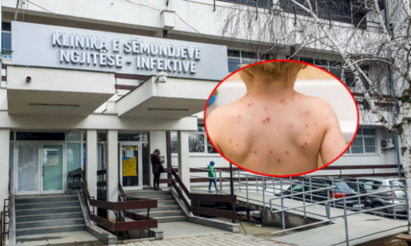 ikshpk:-per-nje-muaj-jane-konfirmuar-14-raste-te-fruthit,-vaksinoni-femijet-–-rreziku-per-komplikime-eshte-serioz